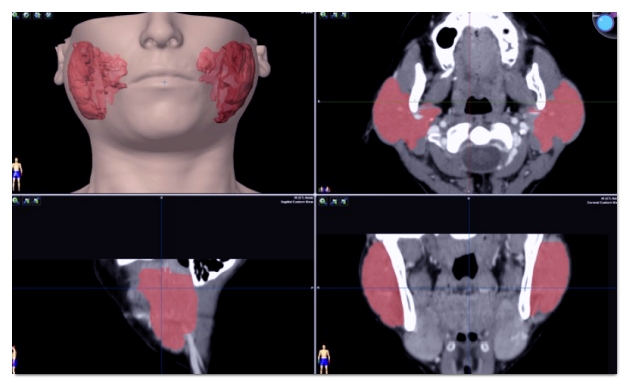 Read This Before You Regret Getting Salivary Gland Botox in Hongdae image 6