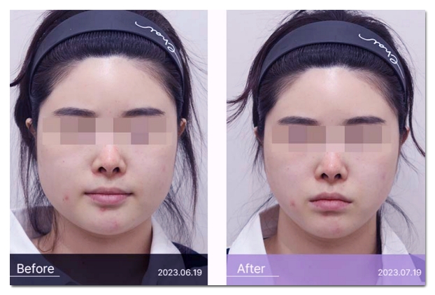 Hongdae Square-Jaw Botox: Should You Get It at a Dental Clinic or Dermatology Clinic? image 4