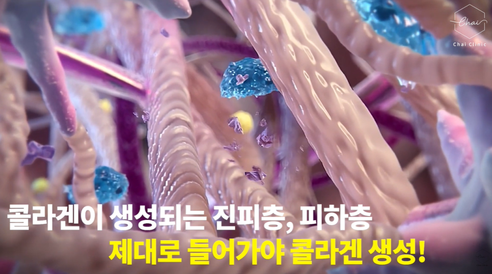 The 233 Rule for Reducing Sculptra Nodule Side Effects in Hongdae image 9