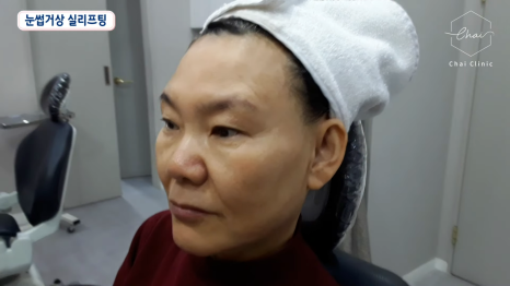 합정 블루다이아리프팅 비용, 5세대 실리프팅은 더 좋나요? 관련 이미지 4