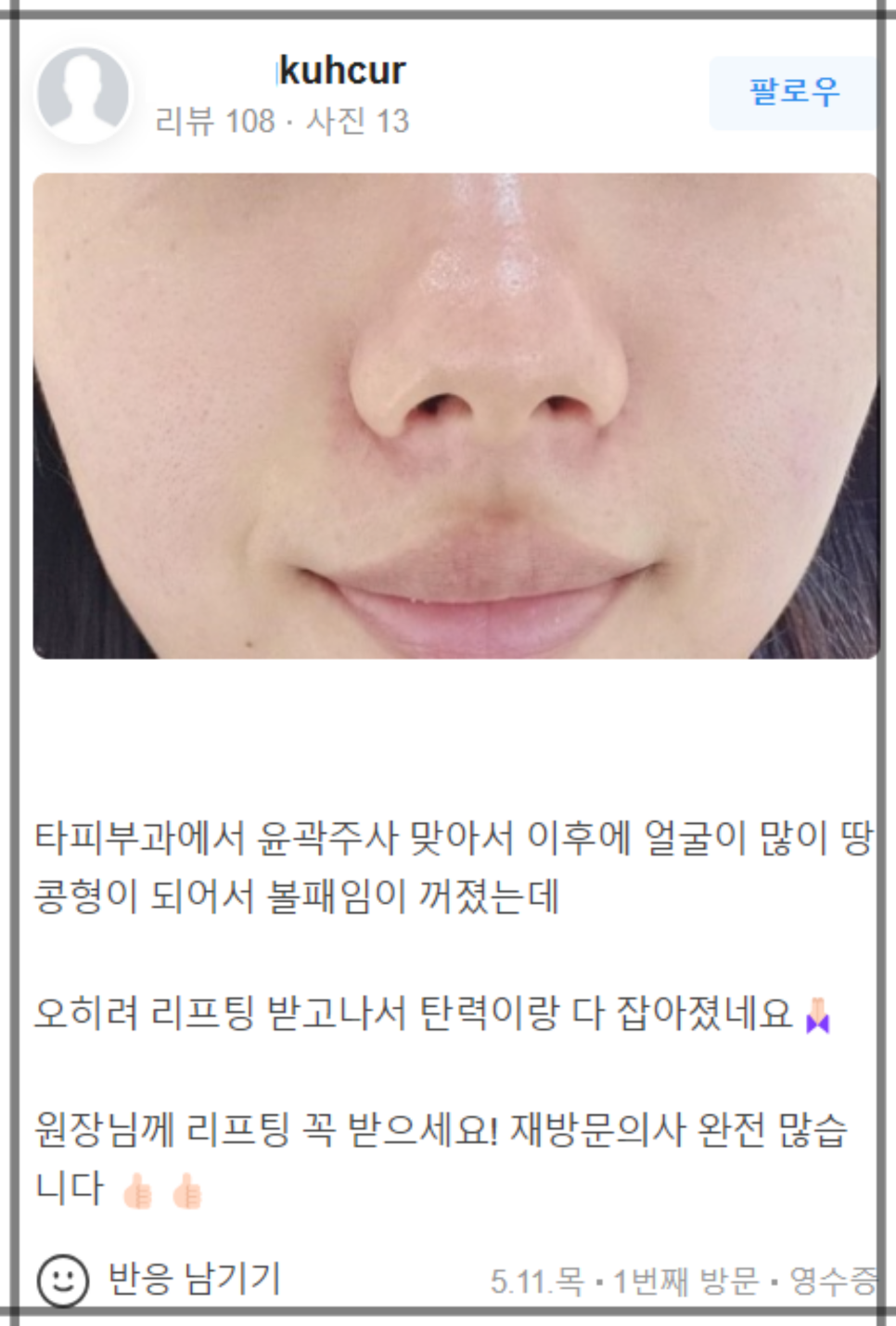 합정 입술필러유명한곳 찾아가는 이유! 관련 이미지 15
