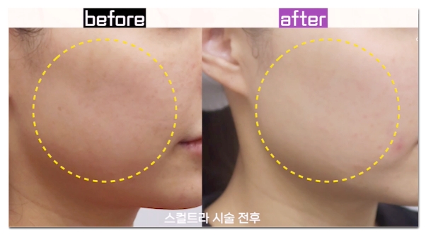Hongdae Sculptra: The 233 Rule for Treatment Without Worrying About Nodules image 5