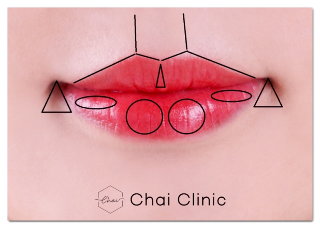 3 Characteristics of a Good Place for Lip Fillers in Hapjeong image 4