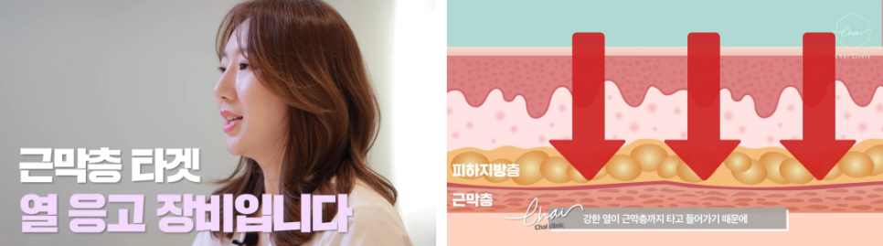 슈링크 울쎄라 8년차 의료진이 쉽게 설명해드릴게요 관련 이미지 3