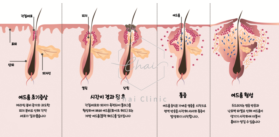 당산 여드름 흉터 맞춤 상담 받으세요 관련 이미지 2