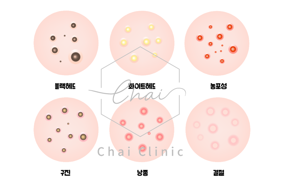홍대 여드름 흉터 치료 후 관리 방법은? 관련 이미지 3