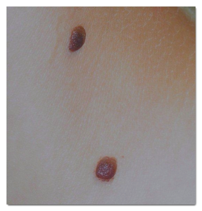 홍대 점제거 깨끗하게 빼기 위해서 알아야 할 3가지 관련 이미지 5