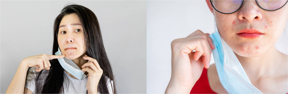 여드름흉터제거 이 글 하나로 관련 이미지 1