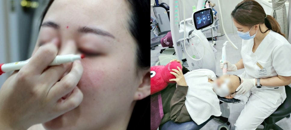 남자코필러, 콧대 각도 높이는 강력한 방법 관련 이미지 7