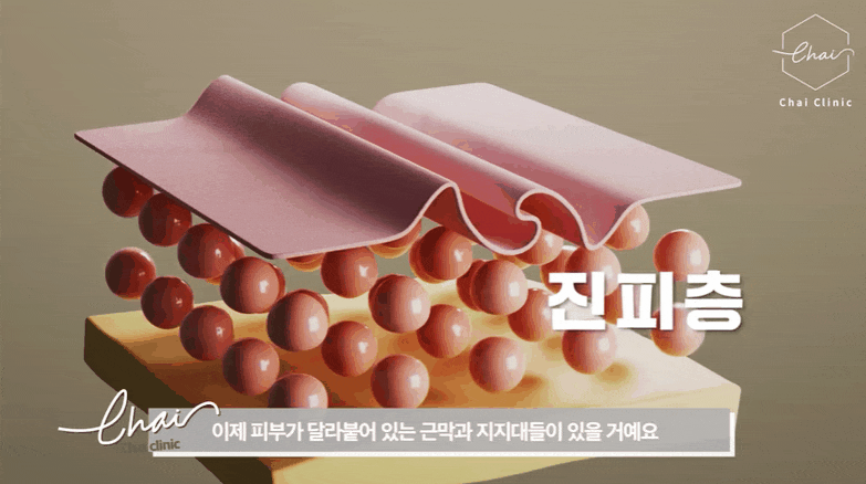 울쎄라 효과시기 제대로 보려면 &lsquo;이것&rsquo; 중요합니다 관련 이미지 1