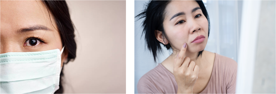 팔자 실리프팅, 한층 더 밝은 미소를 위해 관련 이미지 1