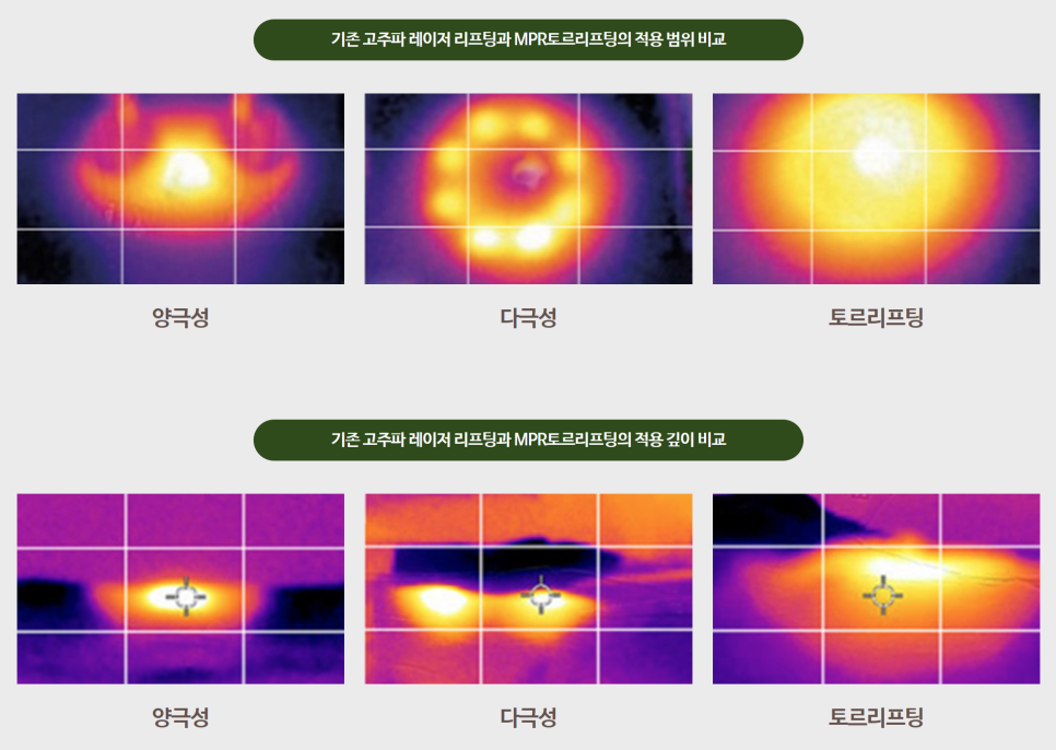 얼굴형시술 갸름하고 예쁜 브이라인 만들기 관련 이미지 9