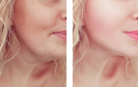 V라인주사? 효과 없다는 말 믿지 마세요 관련 이미지 5