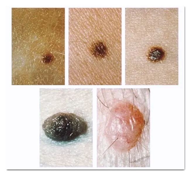 홍대 점제거 깨끗하게 빼기 위해서 알아야 할 3가지 관련 이미지 2
