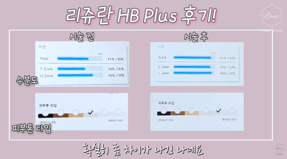홍대 리쥬란 스킨부스터 의사의 내돈내산 후기 관련 이미지 15
