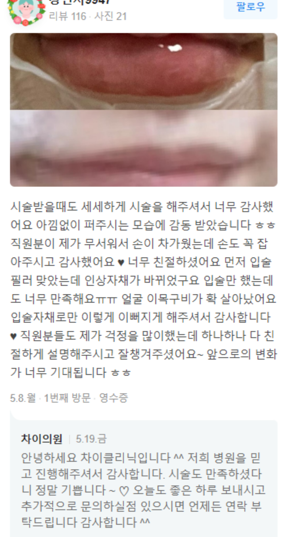 옆광대보톡스 선글라스가 어울리는 얼굴형을 갖고 싶다면 관련 이미지 14