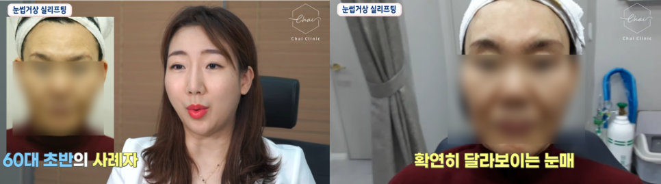 이마실리프팅 부작용 걱정되신다면 ‘이것’ 중요합니다 관련 이미지 8