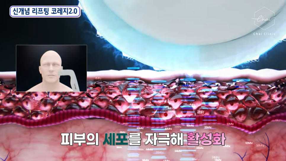 당산 리프팅 나에게 맞는 방법을 추천 받고 싶다면 관련 이미지 4