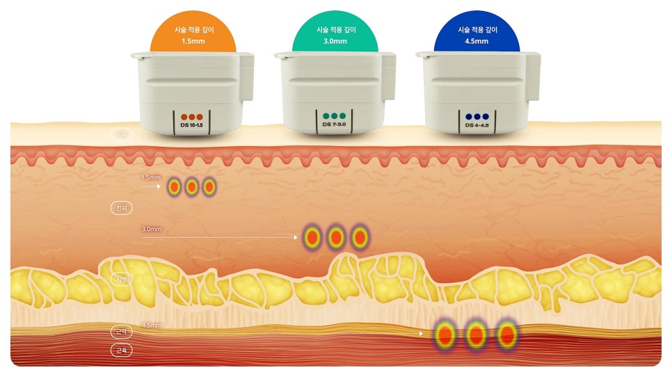 목주름레이저 타임머신효과, 탄력있는 목을 유지하세요! 관련 이미지 6