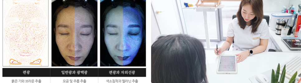 여드름 자국, 관련 이미지 2
