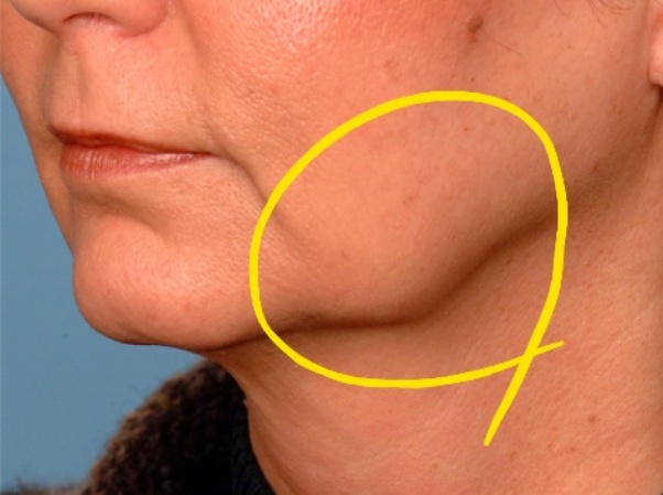 Hongdae Thermage or Ulthera: Which Is Right for My Skin? image 5