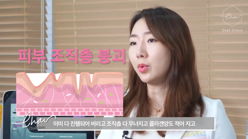 망원 써마지 울쎄라와 고민 중이라면 관련 이미지 3