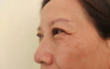 홍대인모드 얼굴 지방 제거와 탄력 모두 잡는 방법 관련 이미지 3
