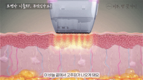 Hongdae Potenza: A Lifting Treatment for Pore Care and Skin Regeneration at the Same Time? image 6
