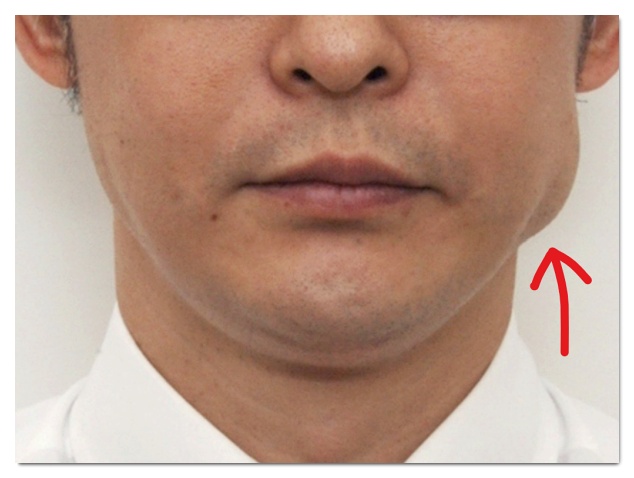 Hongdae Jaw Botox: A Complete Guide to Side Effects That Can Occur While Reducing Jaw Muscles image 6