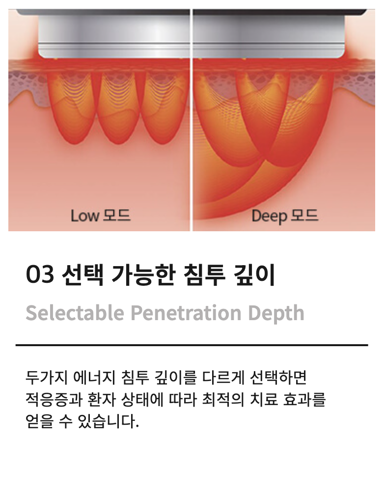 토르 리프팅과 슈링크 유니버스의 병행 시술, 차이핏 리프팅 관련 이미지 5