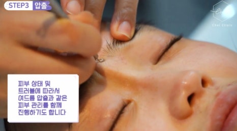 LDM관리 차이의원에서 받고 더 큰 효과 누리세요 관련 이미지 7