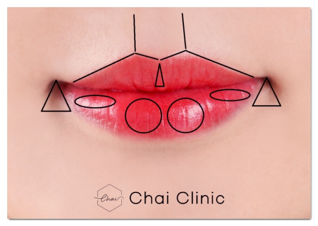 How to Consult So You Can Avoid Filler Side Effects in Hapjeong image 2