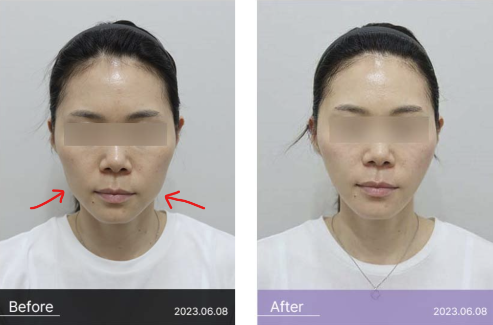 How to Achieve Thermage-Like Results with Corage Lifting image 2