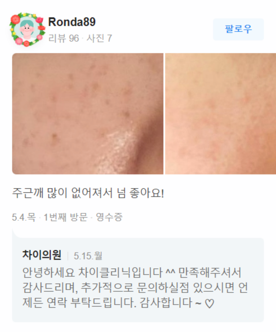 겨드랑이미백레이저 민소매도 자신 있게! 관련 이미지 13