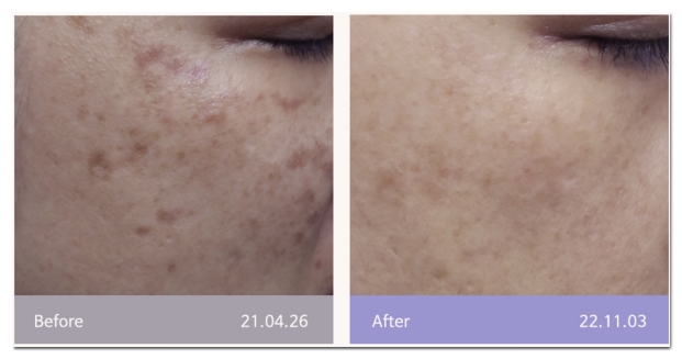 Hongdae Laser Toning: If You Don’t Know This, Melasma Can Actually Get Darker image 4