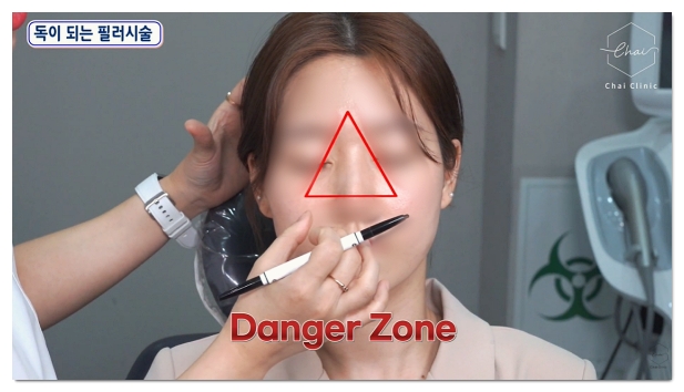 3 Things to Check to See the Effects of Hongdae Forehead Filler image 8