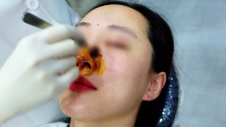 콜라겐실리프팅 차이의원에서 맞춤 디자인으로 받아 보세요 관련 이미지 7