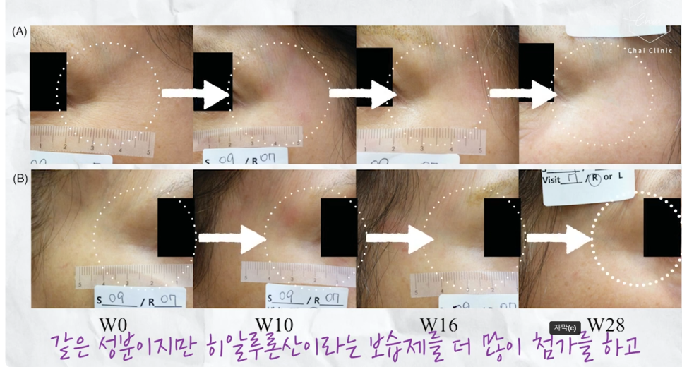 리쥬란 hb 효과, 유지기간, 통증 총정리! 관련 이미지 1