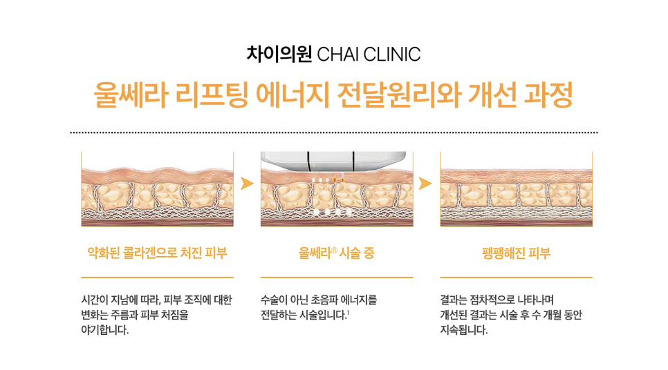 팔자주름 쥬베룩 볼륨의 유의미한 효과 관련 이미지 9