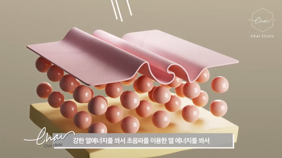 합정 피부관리 울쎄라 정품 확인하는 방법은? 관련 이미지 4
