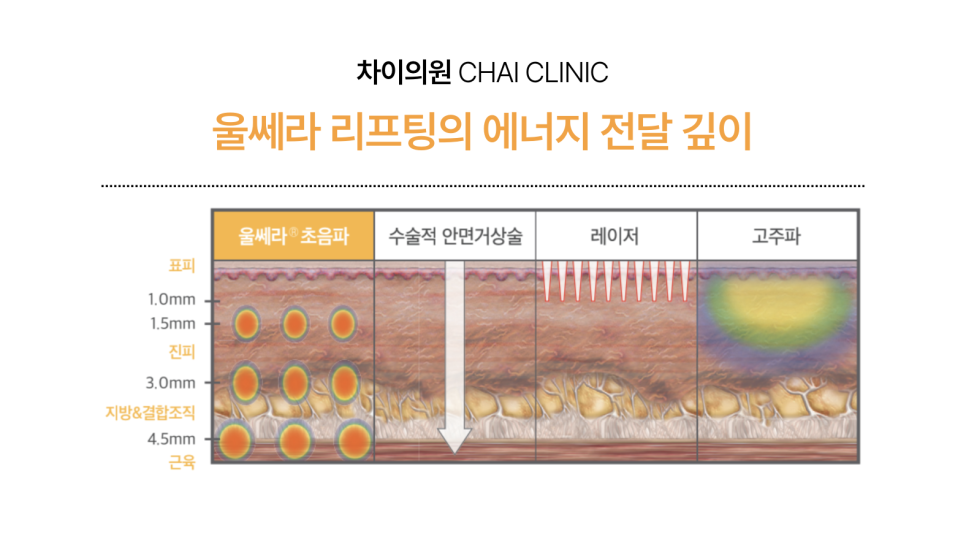 팔자주름 쥬베룩 볼륨의 유의미한 효과 관련 이미지 8