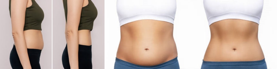 체지방분해주사 쉽고 빠르게 휴가철 비키니 몸매 완성! 관련 이미지 3