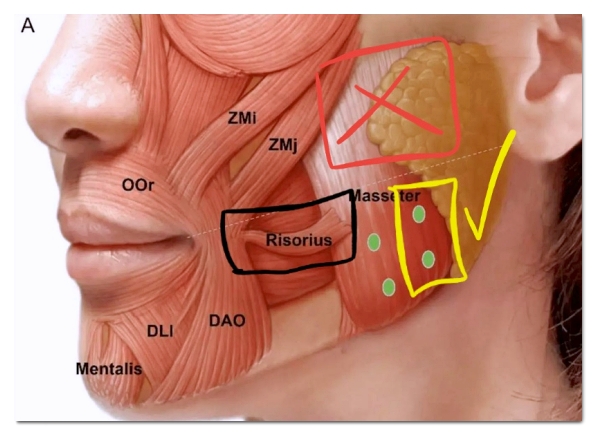 Why Can a Bad Chin Botox Injection Make Your Face Look Bigger in Hongdae? image 4