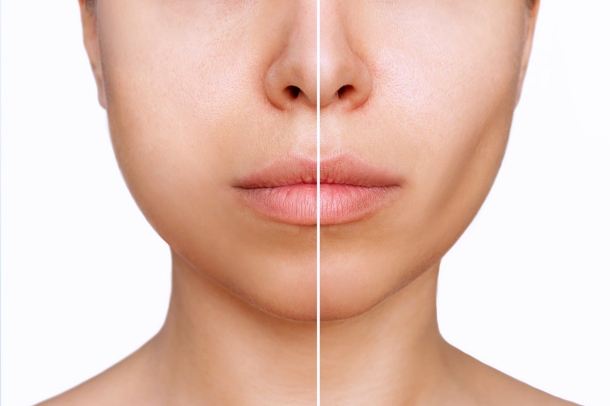 How to Improve the Effect of Hongdae Ultherapy Prime image 5