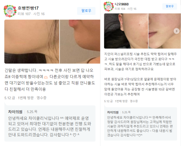 사각보톡스 불룩한 턱선을 V라인 얼굴로 관련 이미지 13