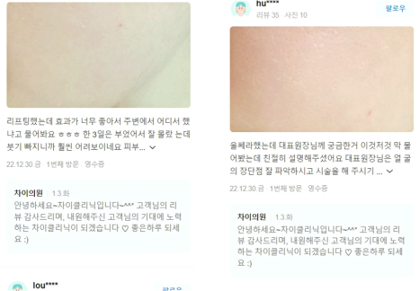 눈썹리프팅 수술 없이 시원한 눈매 완성하는 방법 관련 이미지 16