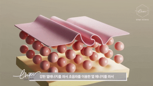 Hongdae Ulthera, the Overall... image 6