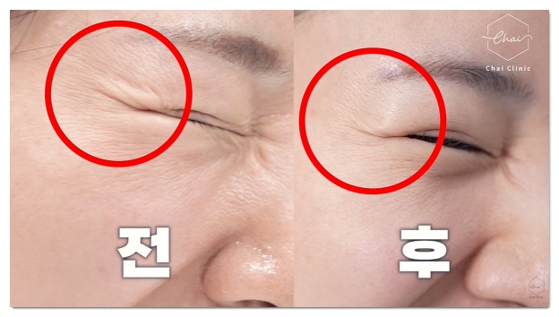 Why Iseurf Uses a Dedicated Eye-Area Tip for Wrinkles Around the Eyes image 11
