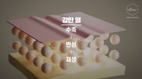 홍대울쎄라 잘 하는 곳 선택하는 기준 알려드려요 관련 이미지 7