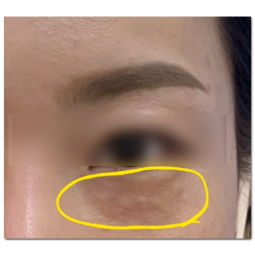 Three Ways to Prevent Juvelook Nodules and Side Effects in Hongdae image 3